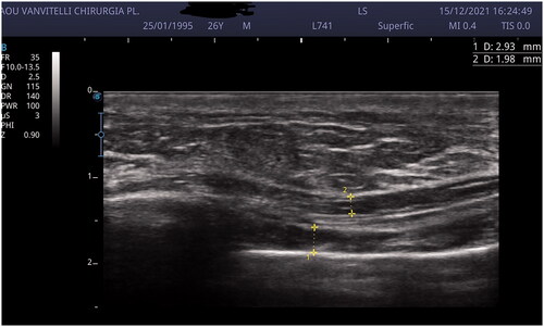 Figure 3. US scan showing thrombophlebitis of the right thoracoepigastric vein.