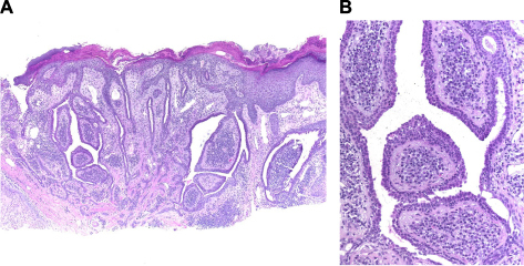 Figure 5 Epidermal tumor with glandular differentiation.