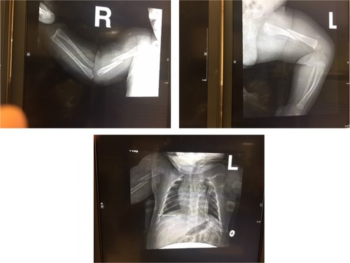 Figure 1 Fractures at initial presentation.
