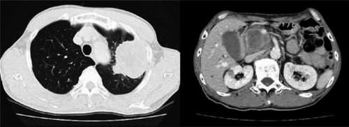 Figure 1 Tumors in the left upper lobe of the lung (left) and in the porta hepatic (right).