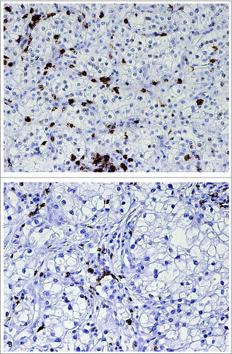 Figure 5. Immunohistochemical stainings of CD8+ T lymphocytes (brown) in renal cell carcinoma tissues representing (A) high and (B) low CD8+ TIL counts.