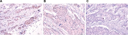 Figure 7 Representative immunohistochemical staining for ZHX3 in breast cancer.Notes: (A) Strong staining of ZHX3 in breast cancer tissue. (B) Moderate staining of ZHX3 in breast cancer tissue. (C) Weak staining of ZHX3 in breast cancer tissue. Original magnification, ×400.