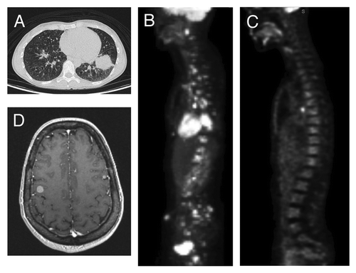 Figure 1. Radiographic findings in patient 1. (A) An initial CT-scan of the chest showed a large tumor arising from the left lower lobe of the lung. (B) An initial staging PET CT-scan showed diffuse FDG avidity suggestive of widespread metastases involving the skeleton. (C) After 6 mo of Crizotinib monotherapy, the patient had a partial response with remarkable improvement in Fluorodeoxyglucose (FDG) avidity seen in a PET CT-scan. (D) An MRI of the brain at 6 mo showed development of 12 brain metastases, two of which are visible in this axial T1-post contrast image.