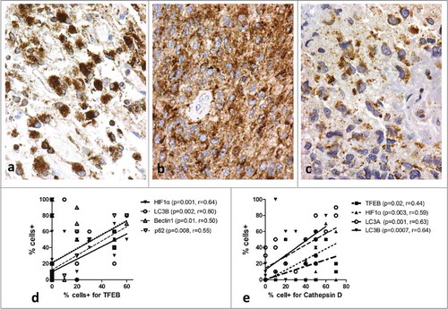 Figure 5. Immunohistochemical images of glioblastoma stained for lysosomal markers, showing granular cytoplasmic expression: (A) Cathepsin D, (B) LAMP2a, (C) TFEB. Linear regression analysis of TFEB (D) and Cathepsin D (E) expression with autophagy markers.