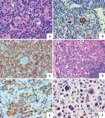 Figure 2 Morphological and phenotypic spectrum of CLL transformation into HL may strongly differ upon histopathological examination.