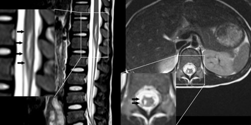 Figure 2 Emergency MRI after the girl recovered from anesthesia in the local hospital.