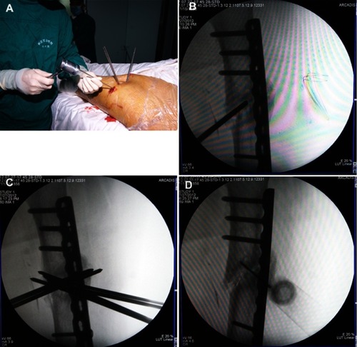 Figure 2 Intraoperative photographs of a patient with femoral shaft nonunion. (A) The drilling process; (B and C) fluoroscopy during drilling; (D) fluoroscopy-guided placement of the tip of a concentrated bone marrow (BM) syringe needle in the nonunion gap.