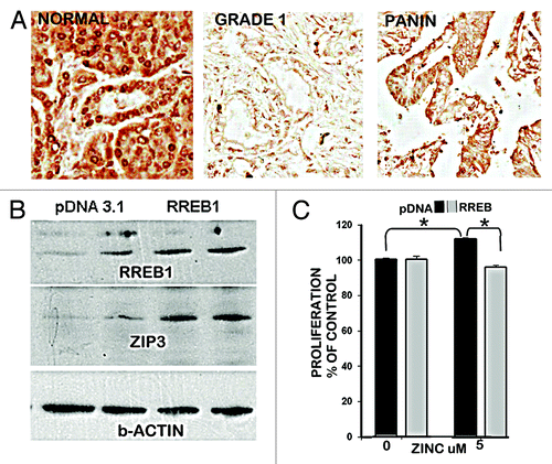 Figure 3. RREB1 in normal vs. adenocarcinoma pancreas and its regulation of ZIP3 and zinc effects on proliferation of Panc1 cells. (A) Immunohistochemistry showing abundant RREB1 in normal ductal and acinar epithelium; and marked decrease of RREB1 (especially nuclear RREB1) in well differentiated malignancy and in the PanIN epithelium. (B) Western blot of effects of overexpression of RREB1 on ZIP3 expression. Lanes are duplicates for pcDNA and for RREB1. (C) The effects of RREB1 expression of the Panc1 cells on cell proliferation in the presence of zinc.