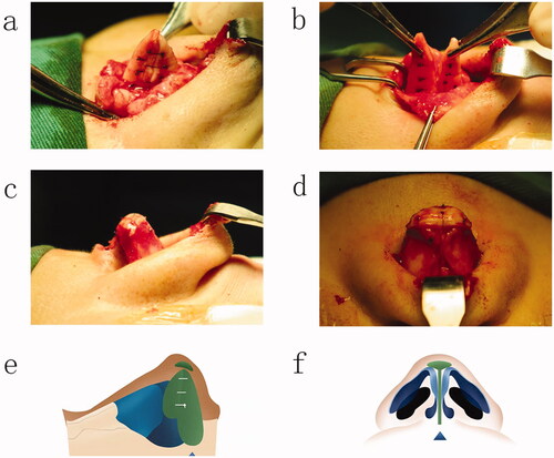 Figure 2. (a) Double tower folded ear cartilage fixed to the nasal septum; (b) folded ear cartilage fixed to the nasal septum; (c) the cap ear cartilage is sutured at the tip of the nose (Lateral view); (d) the cap ear cartilage is sutured at the tip of the nose (anteroposterior view); (e) diagram of the surgical procedure (Lateral view); (f) diagram of the surgical procedure (anteroposterior view).