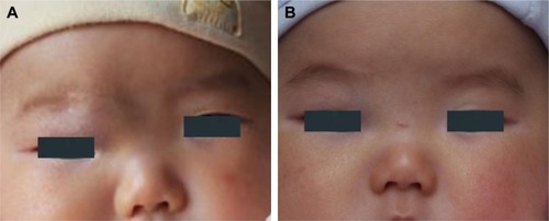 Figure 3 (A) A 3-month-old female patient with a hemangioma located on her right endocanthion. (B) The same patient with the treatment of oral propranolol for 3 months exhibited involuted hemangioma.