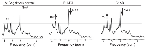 Figure 1 Proton MRS spectra from healthy elderly (A), an elderly subject with MCI (B) and an AD patient (C). Spectra were scaled to creatine peak intensity.
