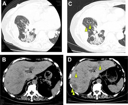 Figure S1 (A) Chest CT just before erlotinib monotherapy. (B) Abdominal CT just before erlotinib monotherapy revealed multiple liver metastases. (C) Chest CT at day 14 of erlotinib monotherapy. Pulmonary small nodules of right lower lobe appeared (arrowhead). (D) Abdominal CT at day 14 of erlotinib monotherapy revealed enlarged liver metastases (arrowhead).Abbreviation: CT, computed tomography.