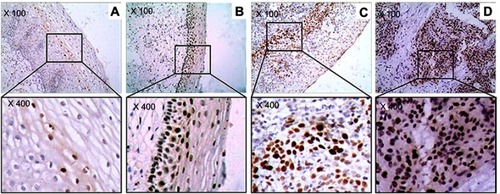 Figure 2 The marker (γH2AX) of DNA damage response in study sample. (A) Cervicitis; (B) CIN I; (C) CIN II/III; (D) SCC. Original magnification, ×100 and ×400.