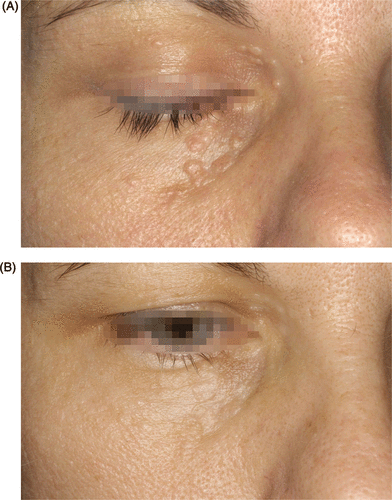 Figure 2. (A) Syringomas in the periorbital region of a 41-year-old woman. (B) Result after four treatment sessions with the argon laser, 1.3 W of power, 2 mm spot size, 300 ms pulse duration.