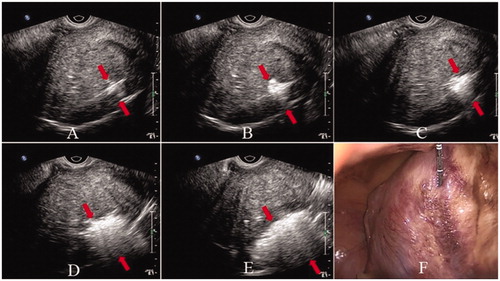 Figure 2. Laparoscope and transvaginal ultrasound images during ablation. Hyperechogenic signal under transvaginal ultrasound guidance indicates ablation area (A–E), and the scope of the hyperechogenic signal becomes larger and larger. Uterus shrinkage and color change from bright red to pale on laparoscope (F). (Red arrows indicate the area of the hyperechogenic signal.)