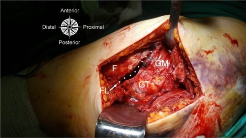 Figure 1 Transtrochanteric approach surgical technique.Note: Accessing the femoral neck from the fracture line on the proximal femur indicated by dots.Abbreviations: F, femur; FL, fracture line; GM, gluteus medius; GT, greater trochanter.