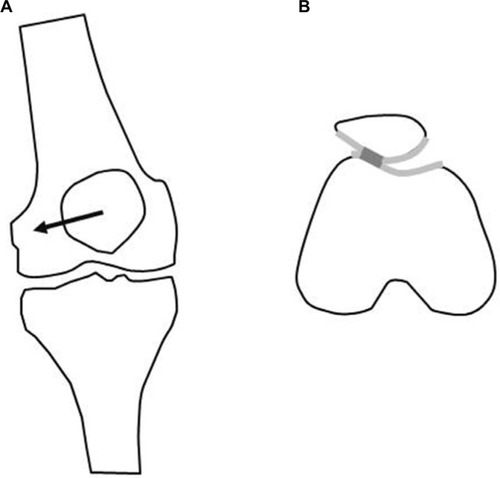 Figure 2 Drawing showing patellar maltracking in PFP patients.