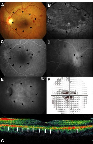 Figure 1 Findings in the left eye at the first visit: (A) the fundus photograph showed a wedge-shaped, dark reddish lesion at the macula (arrowheads), brush- or blotlike intraretinal hemorrhages that spread in a pandirectional manner from the optic disc, a mildly swollen optic disc, and dilated and tortuous retinal veins; (B) scanning laser ophthalmoscopy infrared imaging showed the dark area corresponding to the dark reddish lesion (arrowheads); (C and D) fluorescein angiography revealed hypofluorescence corresponding to the macular lesion (arrowheads) and retinal hemorrhages at the initial phase (C) and retinal phlebitis (arrowheads) and leakages from the optic disc in the late phase (D); (E) on indocyanine green angiography, the dark reddish lesion showed spotted hypofluorescence during the late phase (arrowheads); (F) Humphrey threshold 10–2 perimetry revealed a central scotoma (mean deviation value: −9.40dB); (G) optical coherence tomography showed the loss of the photoreceptor inner/outer segment junction corresponding to the macular lesion (arrows).