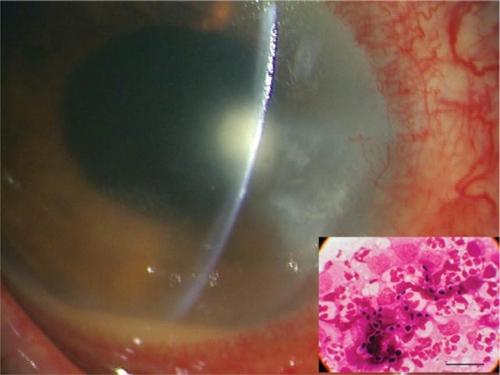 Figure 2 One day after ceasing steroid administration, the corneal endothelial plaque was enlarged and a stromal fluffy abscess with hypopyon formed.