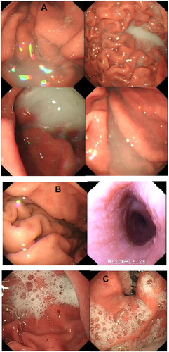 Figure 7 The electronic gastroscope images collected under different conditions.Notes: (A) Poor level gastroscopy images from the control groups: severe obscuration of the gastric mucosa surface caused by paste coming from DM preparations, (B) The clear images from the test group with the DMNs, and (C) Gastroscopy images taken without antifoam: mucus and foam affect vision.