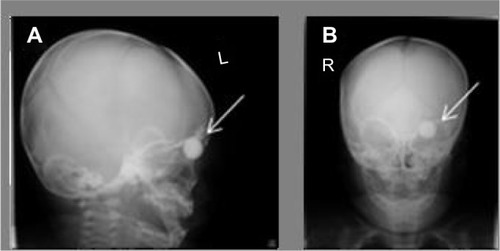 Figure 2 Skull X-ray showed a round opaque foreign body in the left frontal bone region (A) lateral view, (B) antero-posterior view.
