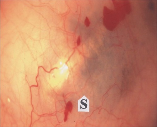 Figure 6 Slit-lamp photograph of the affected eye showing the site of original rhinosporidial growth, 5 months after excision showing residual staphyloma (S). The red patches are subconjunctival hemorrhages.