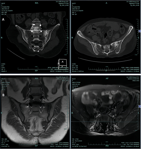 Figure 2 Sacroiliac joint imaging examination results revealed osteitis of the left sacroiliac joint.