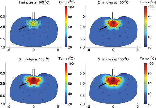 Figure 4. Calculated temperature field within tissue unit volume following 12 minutes ablation by CITT at maximum temperature of 100°C at the CITT tip. Includes high blood flow and assumes that the tip conforms to the tissue.