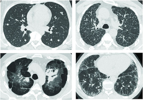Figure 4. CT findings in patients with pulmonary sarcoidosis.The two scans in the first row show typical CT findings. The two scans in the bottom row show fibrosis and emphysema (dark areas). Provided by and reproduced with permission from Divya C Patel, Adjunct Clinical Associate Professor; Division of Pulmonary, Critical Care, and Sleep Medicine; University of Florida College of Medicine; Gainesville, FL, USA.