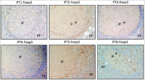 Figure 2. Treg localization in FL tissues. Immunohistochemical staining for Foxp3 (dark brown) was done on formalin-fixed, paraffin-embedded lymph nodes of 6 FL patients before treatment. Original magnification ×200. IF, intrafollicular; PE, perifollicular. *denotes 3 cases exhibiting prominent intrafollicular localization.