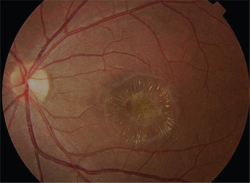 Figure 3a Color fundus photograph of left subfoveal choroidal neovascularization demonstrating subretinal fluid, intraretinal lipid exudate, and subretinal hemorrhage.