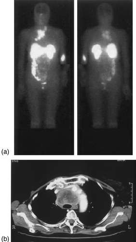 Figure 1.  Images before treatment. 111In octreotide scans (upper) show uptake in the mediastinum. CT-scan images (lower) show a mass in the mediastinum.