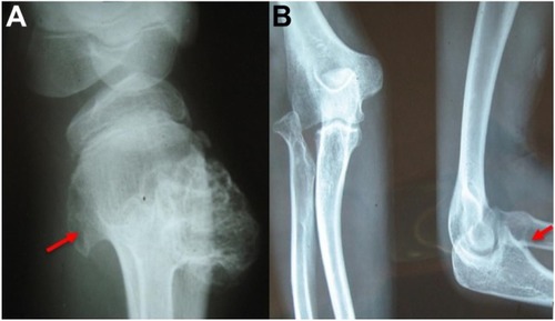 Figure 3 Hereditary multiple exostoses. (A) Radiography of the right knee (lateral view) shows multiple lesions in the proximal portion of the tibia and fibula bones (arrow). (B) Radiographies of the left elbow show multiple lesions in the distal portion of the humerus and proximal portion of the ulna and radius (arrow) bones.