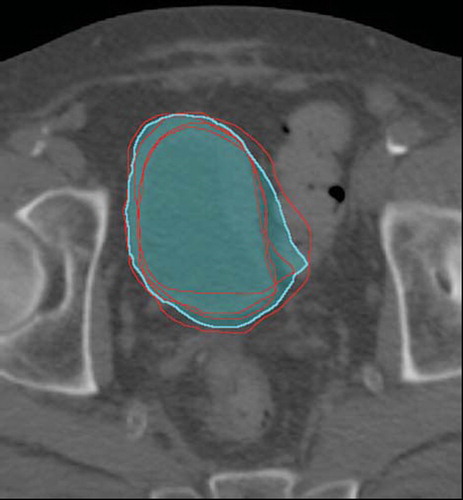 Figure 1. CTV-plan (red line) and daily CTVs as delineated on CBCT-scans for fraction 1 to 4 (red lines). The volume PSVC, Small is segmented in cyan.