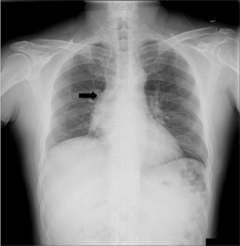 Figure 1 Chest X-ray indicating enlargement of the right hilar area and suspicious mass in the right heart border.