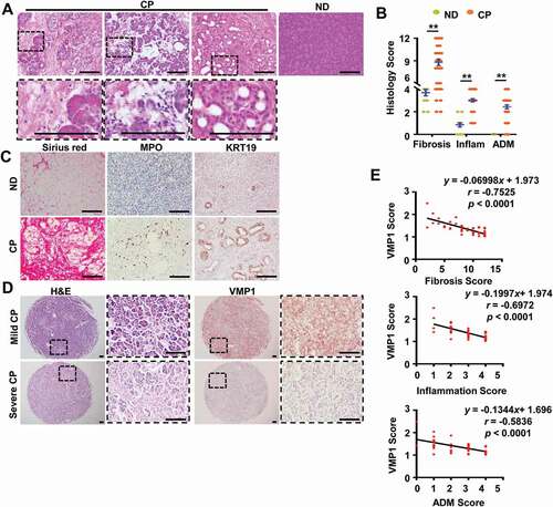 Figure 1. VMP1 staining in human pancreatitis samples. (A) Representative images of H&E staining of human normal and pancreatitis samples. Bar: 100 µm. (B) Individual histology score of H&E staining was graded. Data are mean ± SE (n = 13–52). **p < 0.01; Student t-test analysis. (C) Representative images of Sirius red staining and IHC staining for MPO and KRT19 in human normal donor (ND) and CP tissues. Bar: 100 µm. (D) Representative images of VMP1 IHC staining in human mild and severe CP tissues. Bar: 100 µm. (E) Correlation of VMP1 staining score with fibrosis, inflammation, and ADM scores.