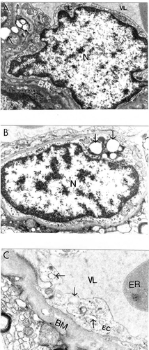 Figure 1 Ultrastructural characteristics of brain microvessels from human Alzheimer disease brain biopsies. A: Microvessels with minimal changes did not show any particular pathology in the ultrastructure of the vascular endothelium; however, perivascular cells show the presence of vacuolar degenerative structures in the matrix (indicated by single arrow). B: Vascular endothelium and perivascular cells of damaged microvessels display ultrastructural lesions in their cytoplasmic organelles especially mitochondria. Completely damaged matrices appeared to be permanent features of all of these cells (indicated by single arrow). Original magnification ×20,000 (A and B). C: Vascular endothelium with non-reversible damage have completely damaged mitochondria and destructive changes in the membranous structures. The basal membrane (BM) is very thick and occupies a large area of the vascular wall. Original magnification ×12,000.