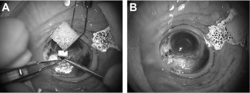 Figure 7 LiDrape® in trabeculectomy. (A) During iridectomy. (B) A filtering bleb immediately after the surgery.