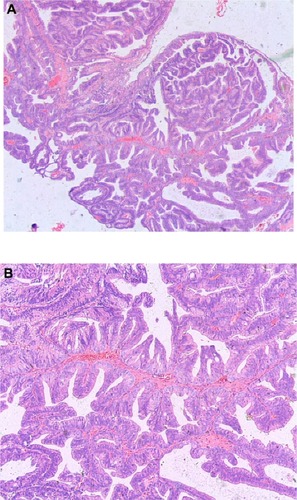 Figure 1 Prostatic ductal adenocarcinoma tumor cells showing a papillary histological pattern.Note: A, hematoxylin and eosin ×25; B hematoxylin and eosin ×50.