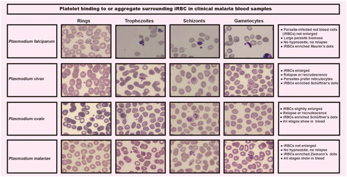 Figure 2. Platelets attach to iRBC in clinical malaria peripheral blood specimens. Platelet-bound iRBC images were captured from a thick blood smear stained with Giemsa at ×1000 magnification utilizing the digital microimaging system with MshOt software.
