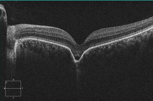 Figure 5 SD-OCT of non-conforming FCE in the macula. In contrast to the conforming type FCE in Figure 4, non-conforming shows a separation of photoreceptor tips from RPE.
