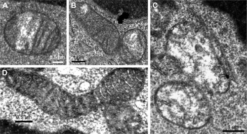 Figure 1 Lymphocytes of patients with ECOPD showing mitochondrial morphological abnormalities, including focal loss of cristae with empty spaces (A) and (B), and swollen mitochondria with severe loss of cristae and matrix (C). (D) Elongated mitochondrion observed in a stable COPD patient.