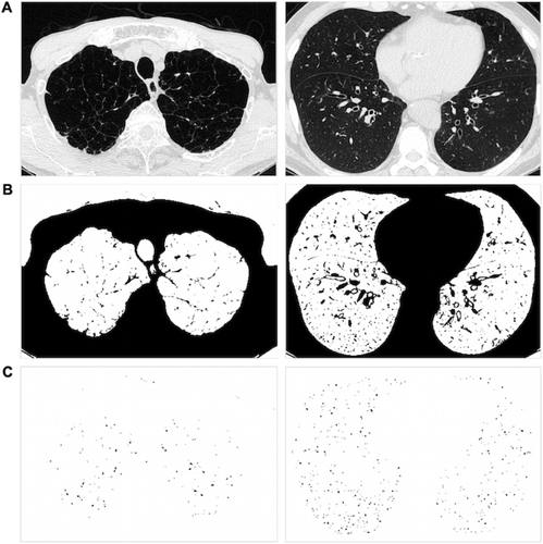 Figure S1 Extracting the pulmonary small vessels as the CSA.Notes: (A) CT images of lung field segmented within the threshold values between −500 and −1,024 HU. (B) Binary images converted from segmented image (A) with a window level of −720 HU. Pulmonary vessels are displayed in black. (C) Mask image for particle analysis after setting vessel size parameters within 0–5 mm2 and the range of circularity within 0.9–1.0.Abbreviations: CSA, cross-sectional area; CT, computed tomography; HU, Hounsfield units.