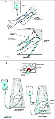 Figure 5. Preservation fluid instillation. (A) ‘In situ’ instillation: While the limb remains attached an infusion catheter is inserted into the brachial artery via arteriotomy. (B) Back table perfusion: Following rapid transection, the donor limb is transferred to the back table where preservation fluid is instilled. Forceps are used to open the arterial lumen.