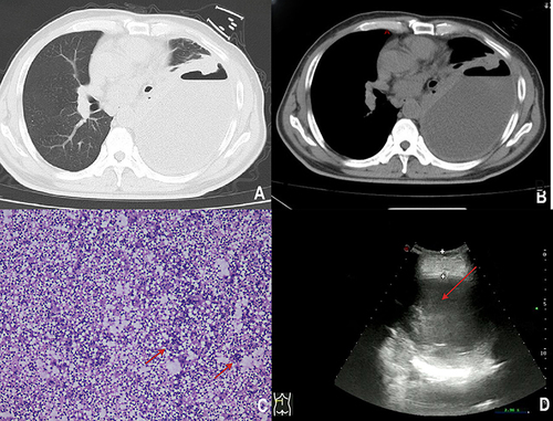Figure 1 (A and B) Chest CT image before treatment. (C) Pathological examination showed numerous neutrophils (as shown by the red arrow), few mesothelial cells, and lymphocytes in the smears and sediment. (D) Chest ultrasound indicates massive effusion (as shown by the red arrow).