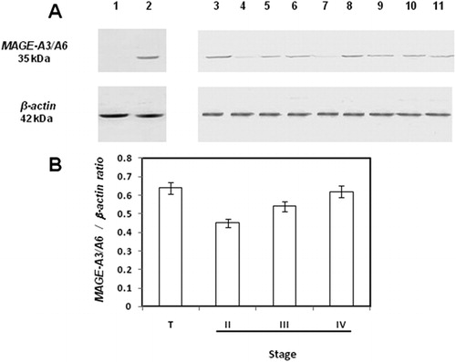 Figure 2. Protein expression of MAGE-A3/A6 in DLBCL stages. (A) MAGE-A3/A6 protein expression in DLBCL. Lane 1, PBLs from a healthy donor; lane 2, testicular tissue; lanes 3–11, DLBCL representative samples. (B) Densitometric semiquantification of the protein bands.