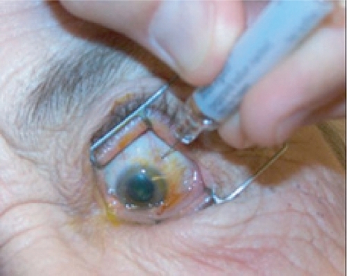 Figure 6d Intravitreal injection given with a 27- or 30-gauge needle through the pars plana.