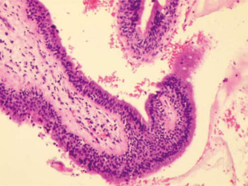 Figure 3 Histopathological examination of a clot specimen showed degenerative necrotic tissue but no epithelial cell component, and congestion and bleeding in the bronchial mucosa.