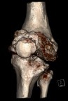 Figure 1 Preoperative 3D-CT.Abbreviations: 3D-CT, three-dimensional computed tomography.