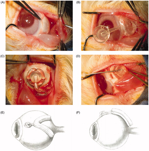 Figure 2. Periocular capsular drug delivery system (DDS) was implanted to the sub-Tenon's sac of rabbit eye. (A) The sub-Tenon's sac was exposed, (B) the periocular capsular DDS was laid in the sub-Tenon's sac, (C) the periocular capsular DDS was fixed on the episclera, (D) the dexamethasone sodium phosphate (DEXP) was injected through the valve and tube to the capsule of the periocular capsular DDS, (E) the schematic diagram of the periocular capsular DDS implanted to sub-Tenon's sac of the upper view and (F) the schematic diagram of the periocular capsular DDS implanted to sub-Tenon's sac of the lateral view.